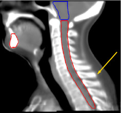 Head and Neck Atlas sagittal slice