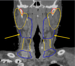 Patient delineated using Head and Neck Atlas (coronal slice)