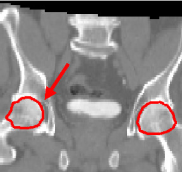 Prostate Floating Image Registered using a Locally Affine Transformation