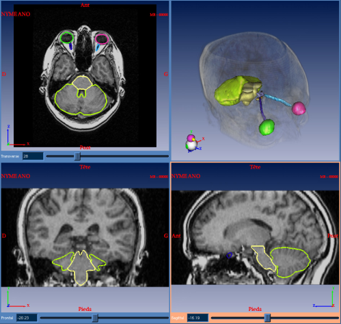 Automatic Segmentation Result Using a Brain Anatomical Atlas